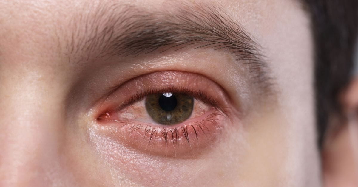 conjunctivitis